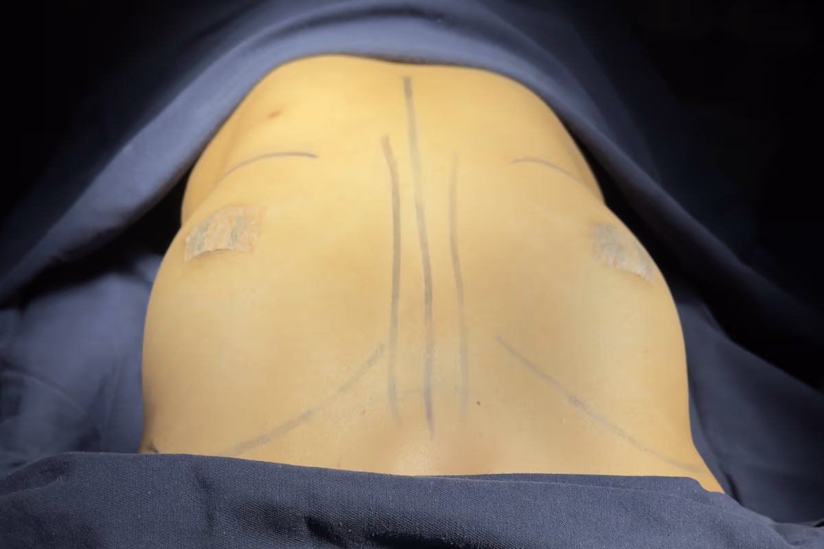 Marcación preoperatoria de mamoplastia de aumento — simulación quirúrgica ALMO Clinic Bogotá Marcación preoperatoria para aumento de senos sobre simulador quirúrgico en ALMO Clinic Bogotá: línea media del tórax, meridiano mamario y surco inframamario