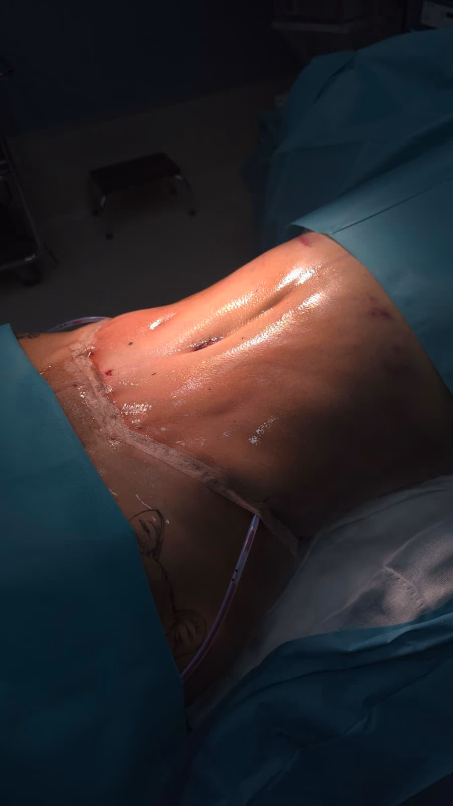 Cirujano plástico certificado SCCP realizando liposucción de alta definición en quirófano habilitado de ALMO Clinic Bogotá