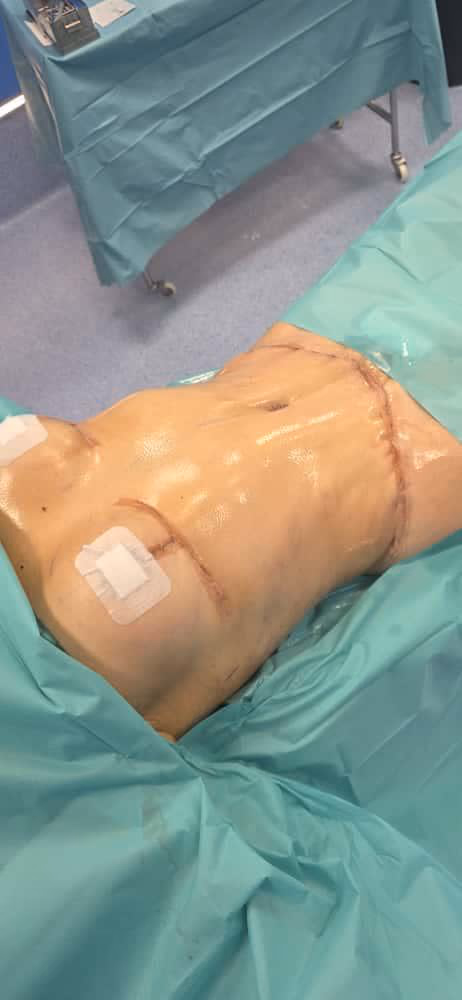 Resultado postoperatorio de lipoescultura en ALMO Clinic Bogotá — contorno corporal redefinido con grasa propia redistribuida