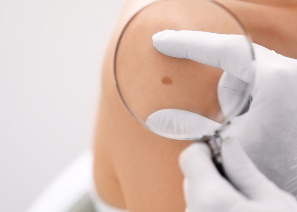 Dermatología oncológica y prevención en ALMO Clinic