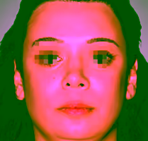 After CO2 laser blepharoplasty - Firm eyelids and fast healing