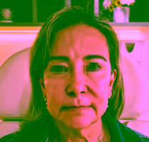 After blepharoplasty in Bogotá - Rejuvenated and rested look