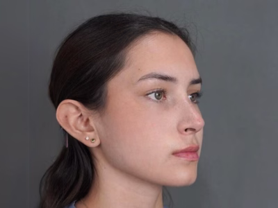 Después del Rinoplastia ultrasónica