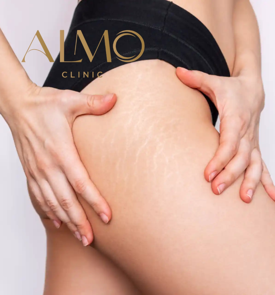 Clasificación estrías Tipos de estrías