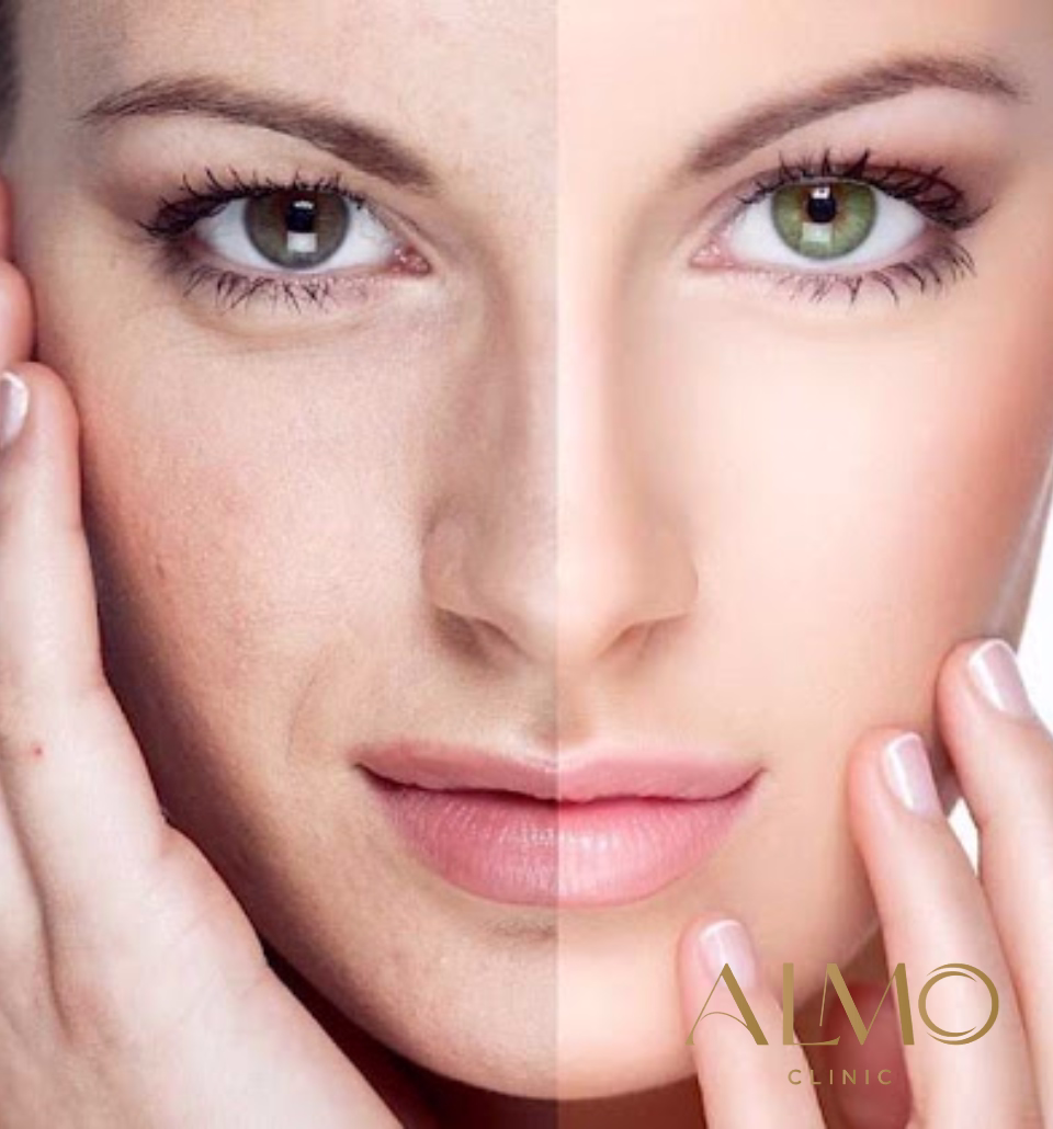 Estudio clínico resultados Morpheus8