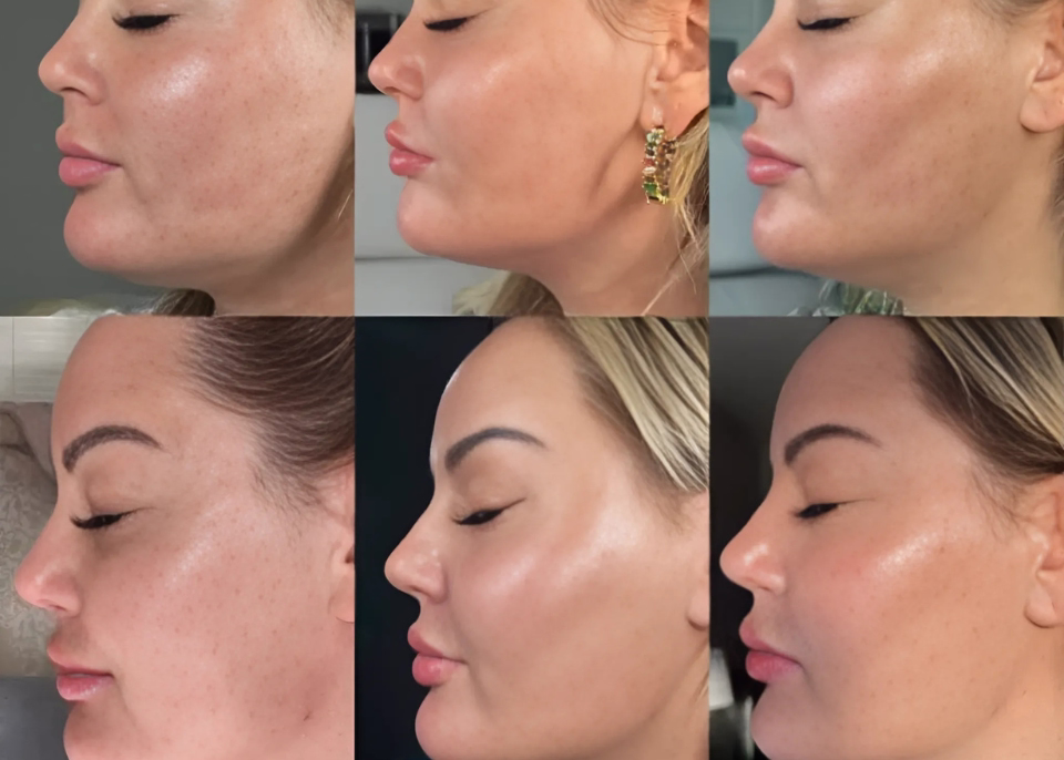 Morpheus8 and Liftera treatment - collagen bomb