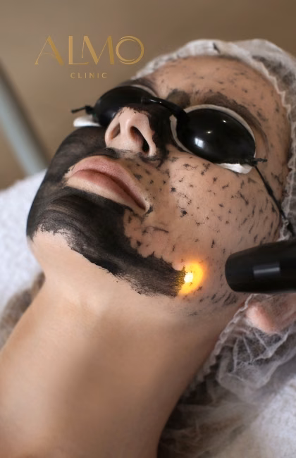 Hollywood Peeling: activated charcoal lotion on the face during the laser passes at ALMO Clinic Bogotá