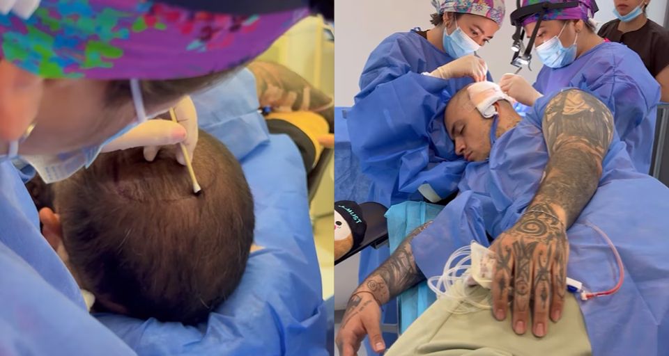 Técnica DHI Bogotá — implantación directa con Choi pen Técnica DHI de implantación directa con Choi pen en ALMO Clinic Bogotá — trasplante capilar de alta precisión