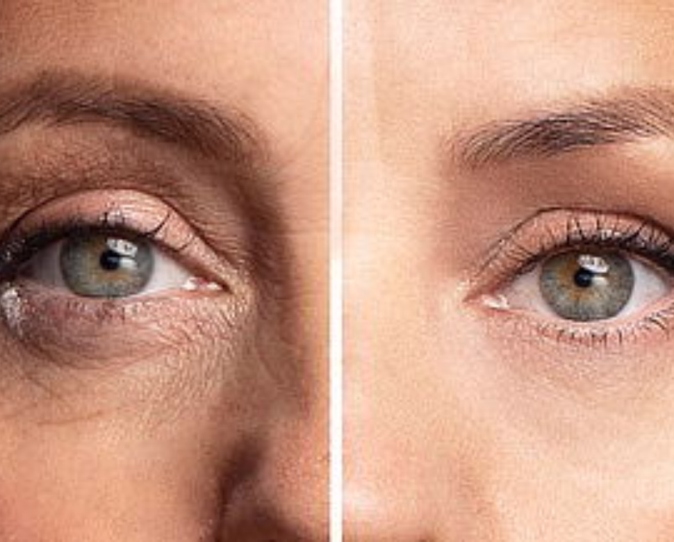 Difference between Liftera vs traditional HIFU