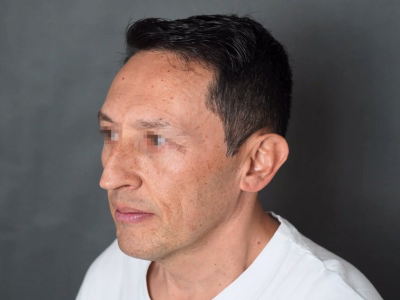 Lifting facial en ALMO Clinic Bogotá