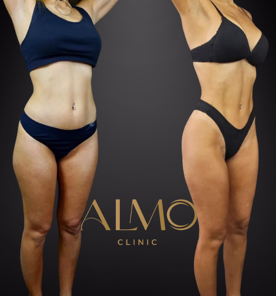 Problema de flacidez residual después de liposucción tradicional