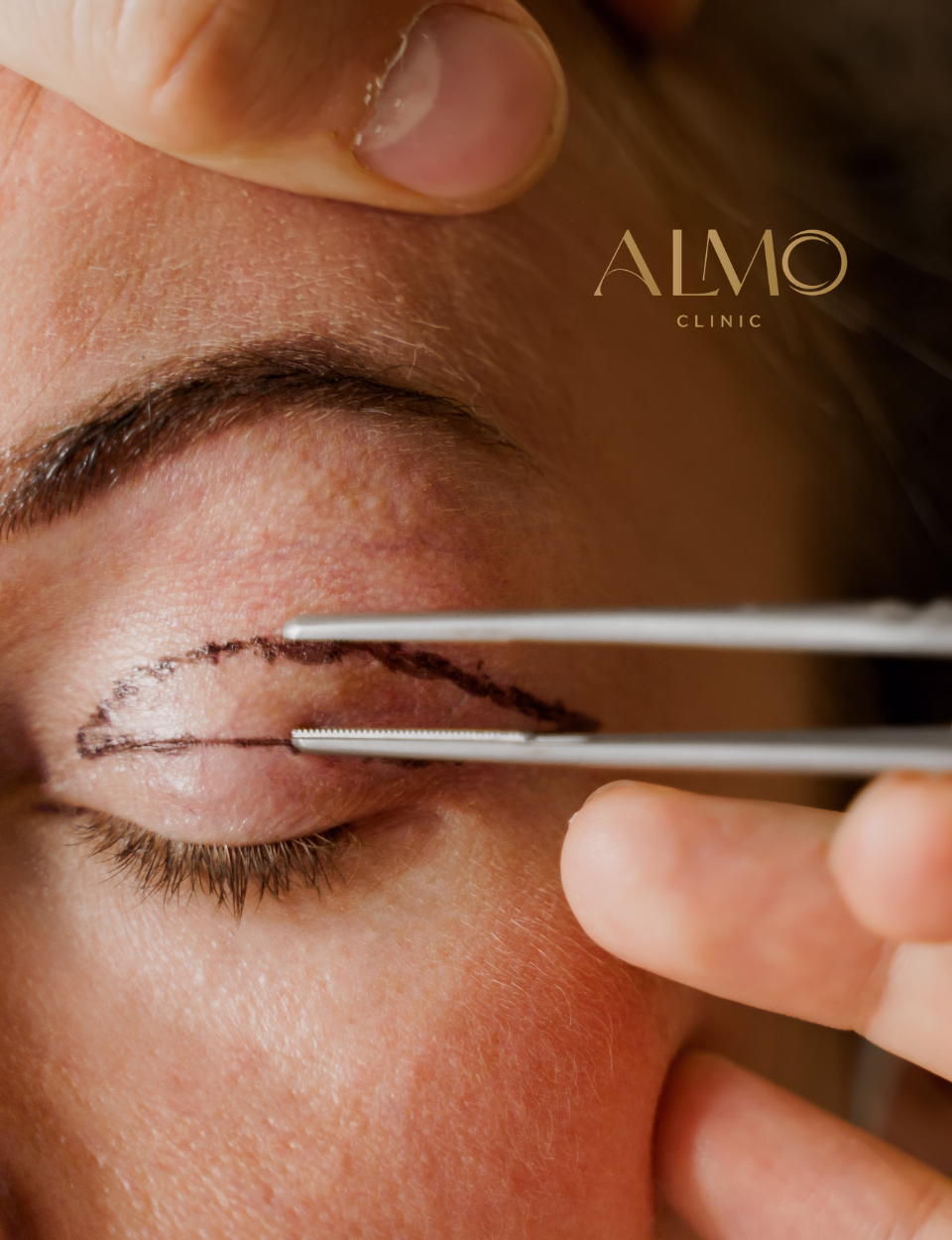 Resultado blefaroplastia en Bogotá — mirada descansada y natural antes y después cirugía de párpados ALMO Clinic