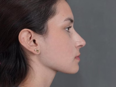 Rinoplastia ultrasónica en ALMO Clinic