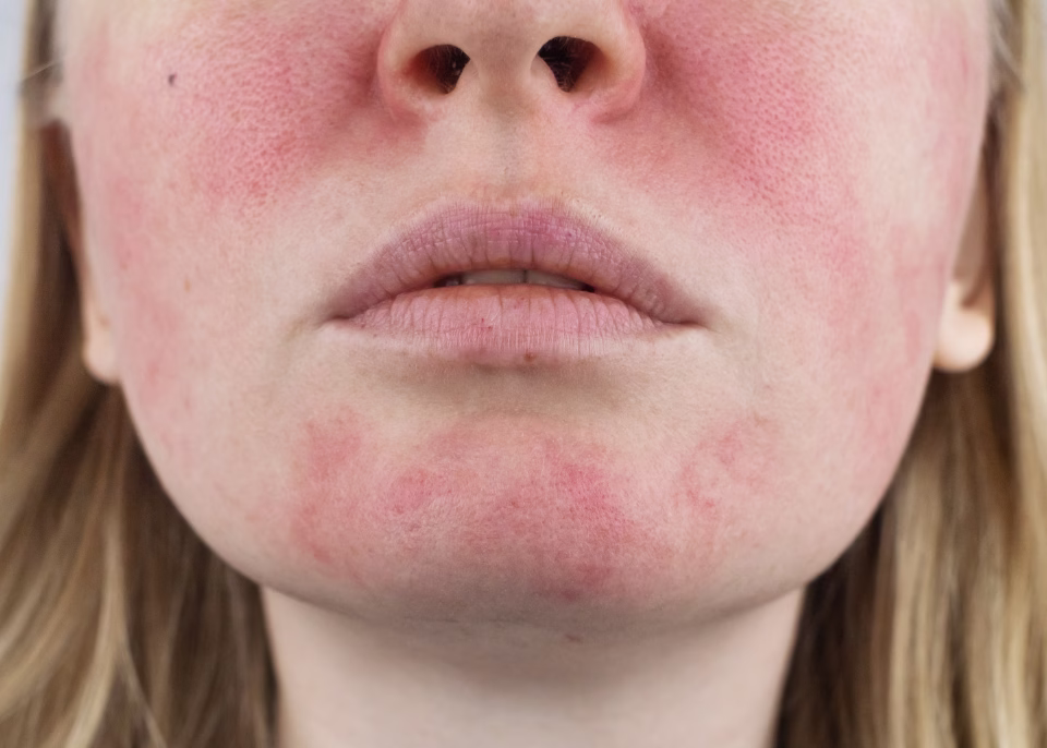 Tratamiento de rosácea con IPL en ALMO Clinic