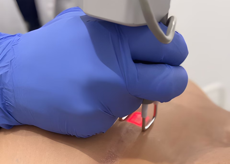 Tratamiento con láser CO2 fraccionado en ALMO Clinic