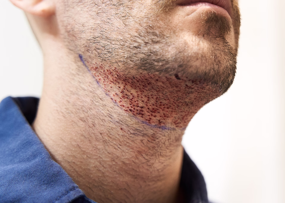 Trasplante de cejas y barba en ALMO Clinic
