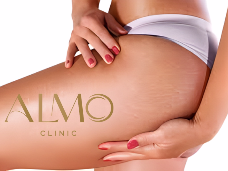 Tratamiento Estrías Bogotá - Eliminación Efectiva Tratamiento de estrías con Morpheus8 en ALMO Clinic Bogotá